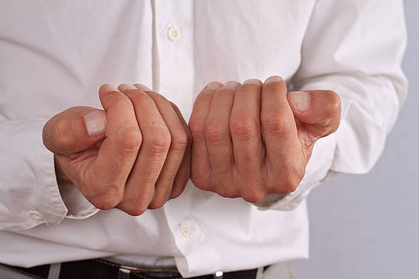 istock Male hands with dry skin. Dermatology 606003296