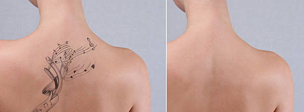 istock Laser tattoo removal before and after. 606006626