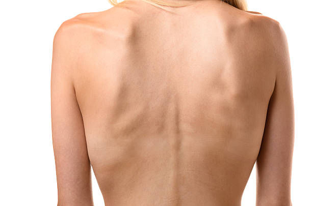 Rear View Of The Back Of A Thin Woman Stock Photo - Download Image Now -  Anorexia Nervosa, Back, Rear View - iStock
