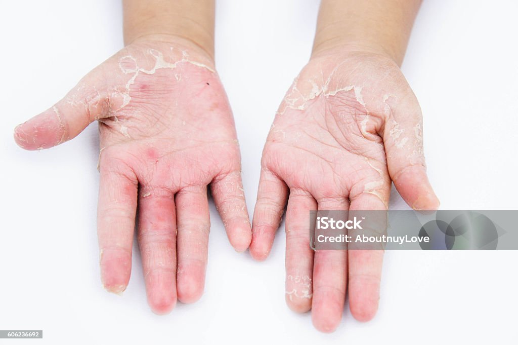 Trockene Hände, Peeling, Kontaktdermatitis, Pilzinfektionen, - Lizenzfrei Allergie Stock-Foto