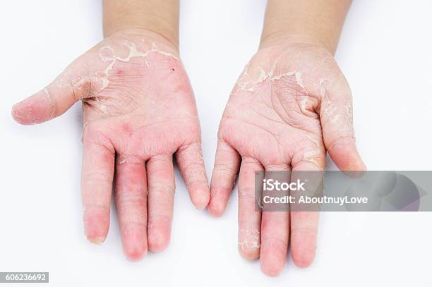 Trockene Hände Peeling Kontaktdermatitis Pilzinfektionen Stockfoto und mehr Bilder von Allergie