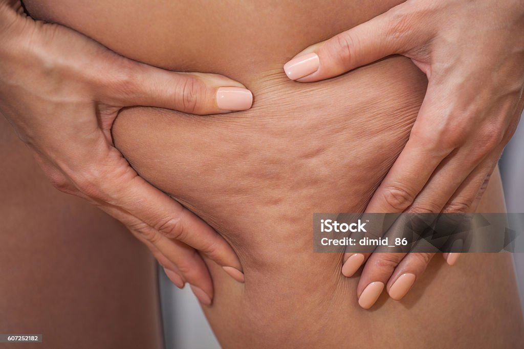 Girl shows  pushing the skin of the legs cellulite. Girl shows holding and pushing the skin of the legs cellulite, orange peel. Treatment and disposal of excess weight, the deposition of subcutaneous fat tissue Cellulite Stock Photo
