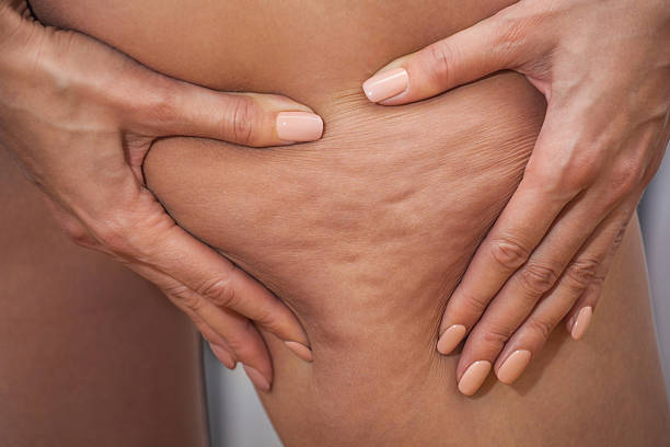 Girl shows pushing the skin of the legs cellulite. Girl shows holding and pushing the skin of the legs cellulite, orange peel. Treatment and disposal of excess weight, the deposition of subcutaneous fat tissue cellulite stock pictures, royalty-free photos & images