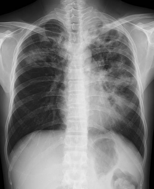 istock Chest x-ray image of pumonay tuberculosis(TB) 607652430