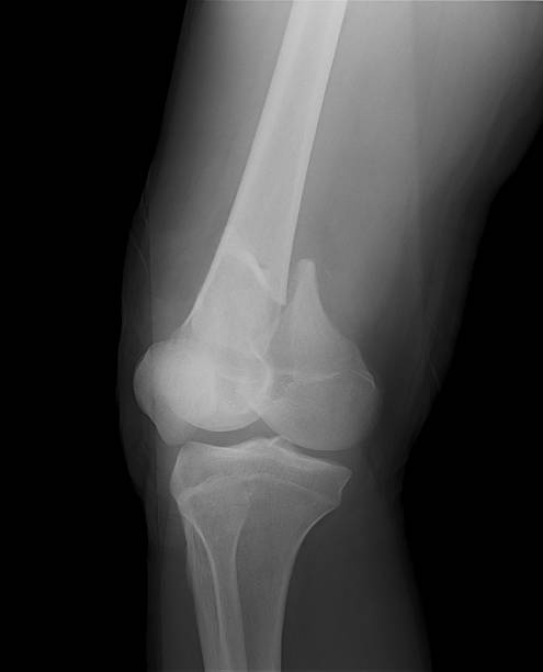 image antéropostérieure du genou montrant une fracture distale du fémur - x ray human knee orthopedic equipment human bone photos et images de collection