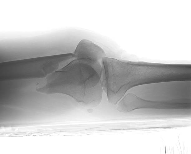 imag aux rayons x du genou cassé - x ray human knee orthopedic equipment human bone photos et images de collection