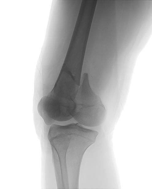 image radiographique antéropostérieure (ap) du genou montrant une fracture distale du fémur - x ray human knee orthopedic equipment human bone photos et images de collection