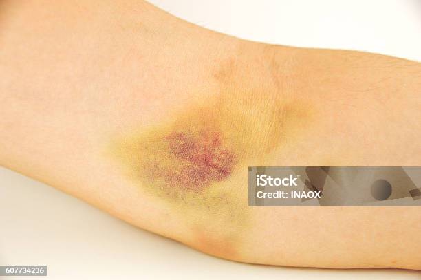 Bruise In The Arm Stock Photo - Download Image Now - Adult, Bruise, Close-up
