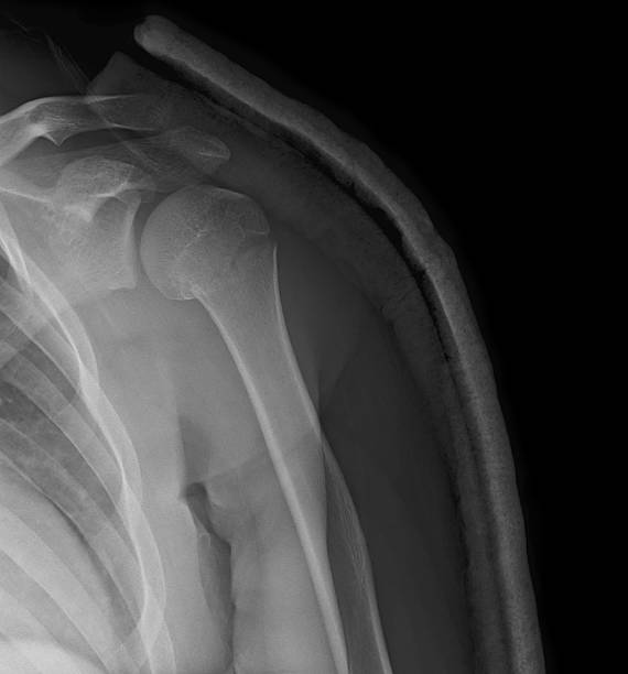 image radiographique de l’épaule montrant une fracture humérale proximale - humerus photos et images de collection