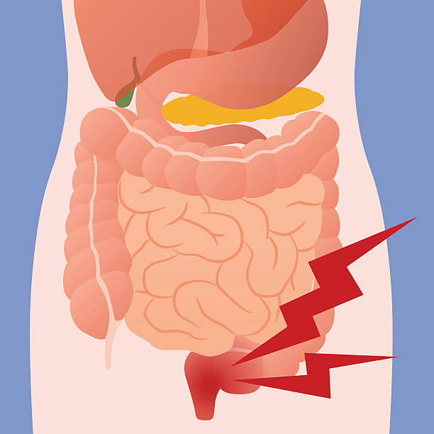 istock inflammation of the intestine and human digestive organs 609440744