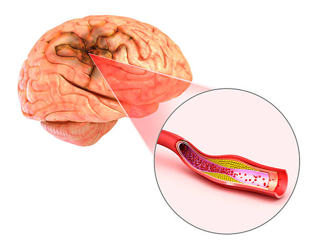 accidente cerebrovascular cerebral : ilustración 3d de los vasos del cerebro y las causas del accidente cerebrovascular - anoxia fotografías e imágenes de stock
