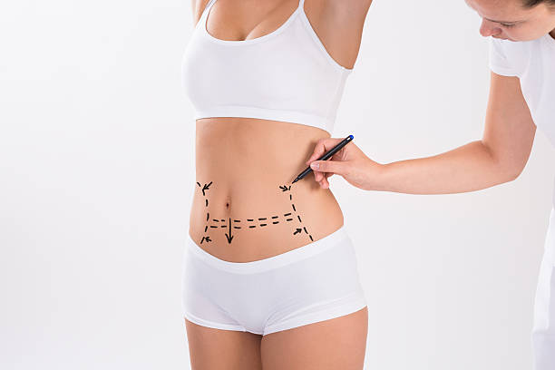 surgeon preparing woman for liposuction surgery - liposuction imagens e fotografias de stock