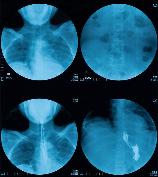 röntgenbild des bariumschluckens, obere magen-darm-serie - barium stock-fotos und bilder