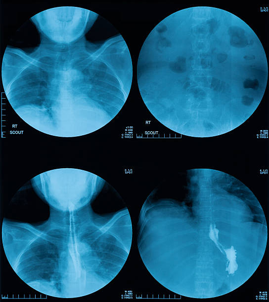 バリウム嚥下のx線画像、上部消化管シリーズ - barium ストックフォトと画像