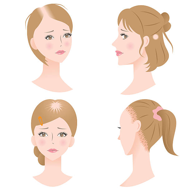 female hair loss women with pattern hair loss get a receding hairline, bald spot on the top or side of the head, and traction by putting the hair under strain. woman hairline stock illustrations