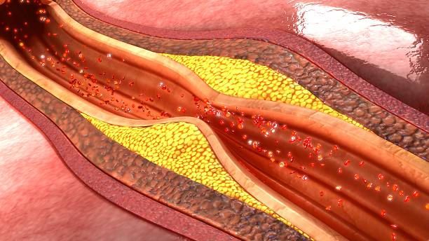 Coronary artery plaque stock photo