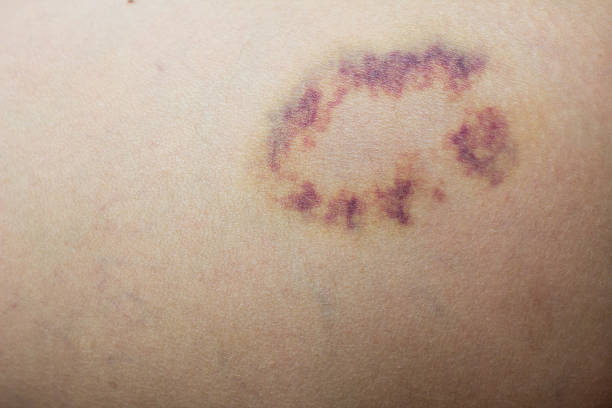 istock Closed up violet lesion on skin 610159350