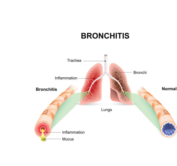 Bronchitis Bronchitis. Lungs and bronchial tubes. normal bronchial tube and a bronchial tube with bronchitis. bronchitis stock illustrations