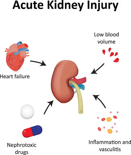 Vector illustration of Acute Kidney Injury Diagram Illustration Renal