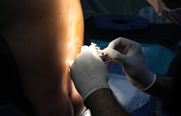 znieczulenie zewnątrzoponowe - surgeon human hand surgery anesthetic zdjęcia i obrazy z banku zdjęć