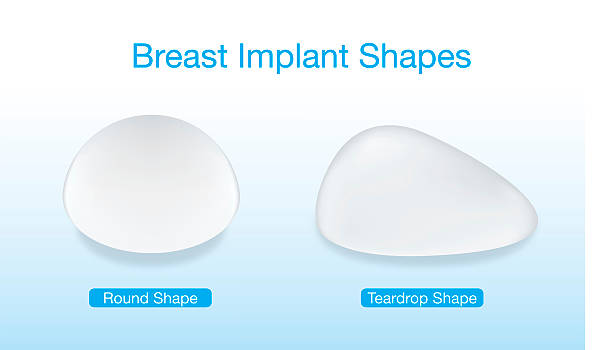 Shapes of breast implant Difference of breast implant round and teardrop shapes. This illustration about cosmetic surgery. silicone implants stock illustrations
