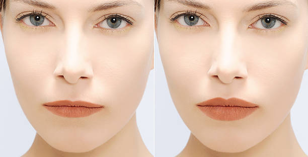 istock woman fill lips - before and after 610748244