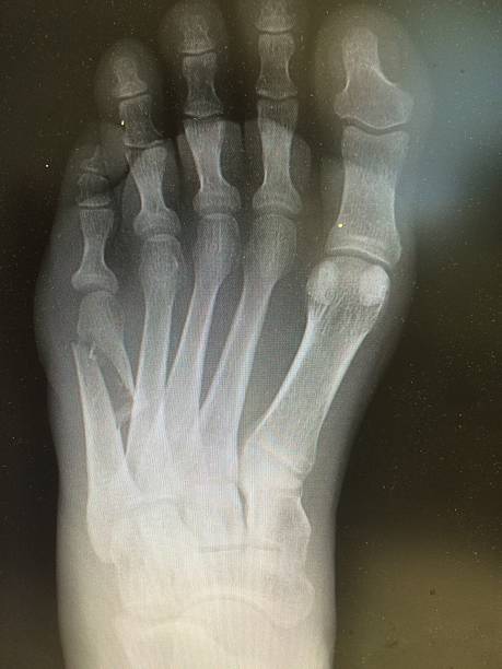 imagen de rayos x de la fractura del pie, vista ap - circa 5th century fotografías e imágenes de stock