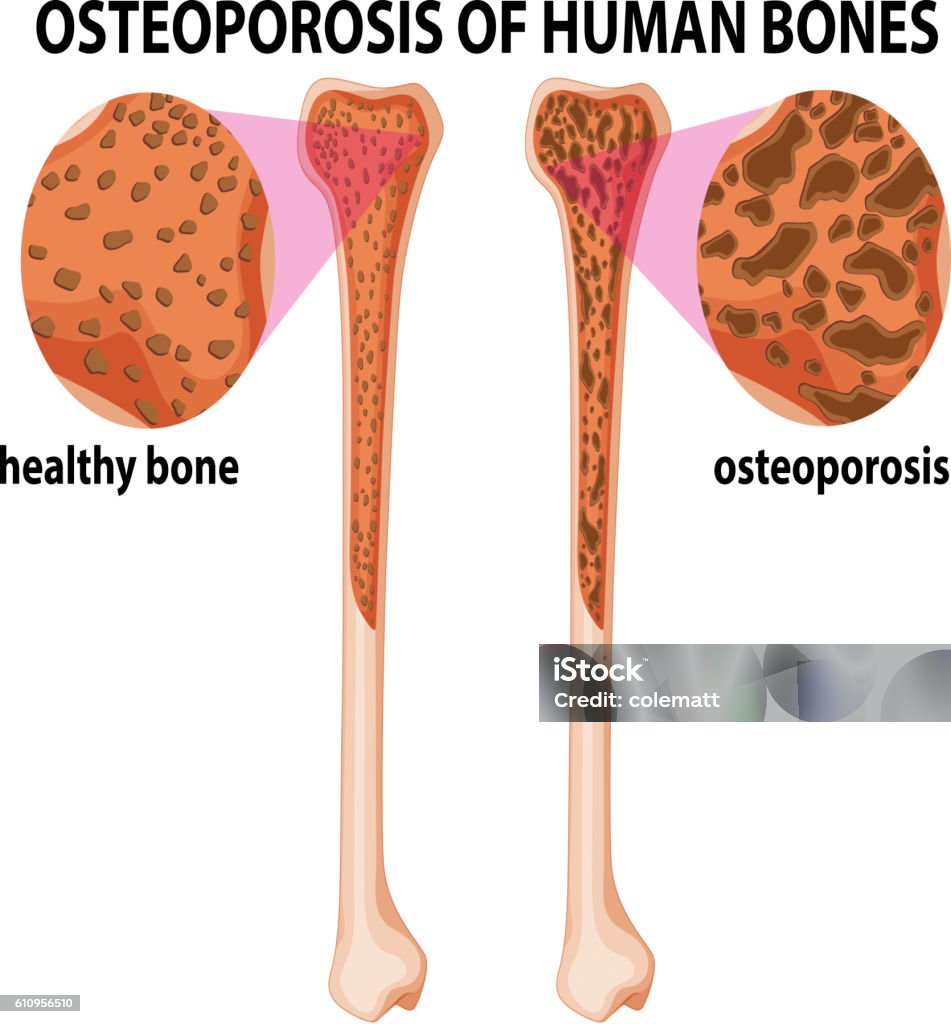 Diagram Memperlihatkan Osteoporosis Tulang Manusia Ilustrasi Stok ... Biology Diagrams