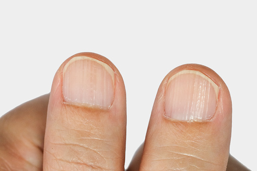 Vertical ridges on the fingernails