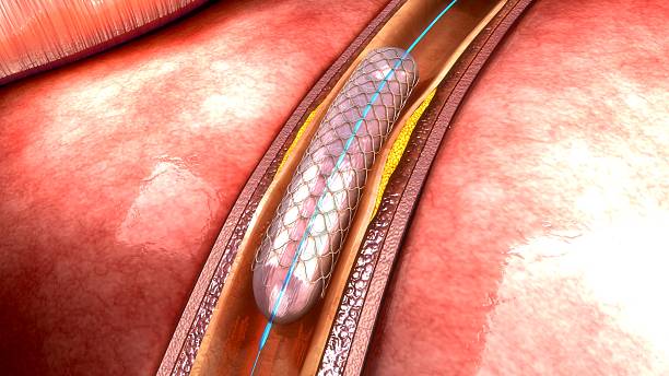 endoprótesis vascular - angioplasty fotografías e imágenes de stock