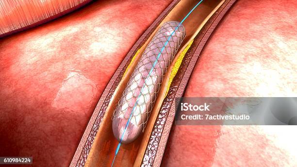 Stent Stock Photo - Download Image Now - Stent, Angioplasty, Coronary Artery
