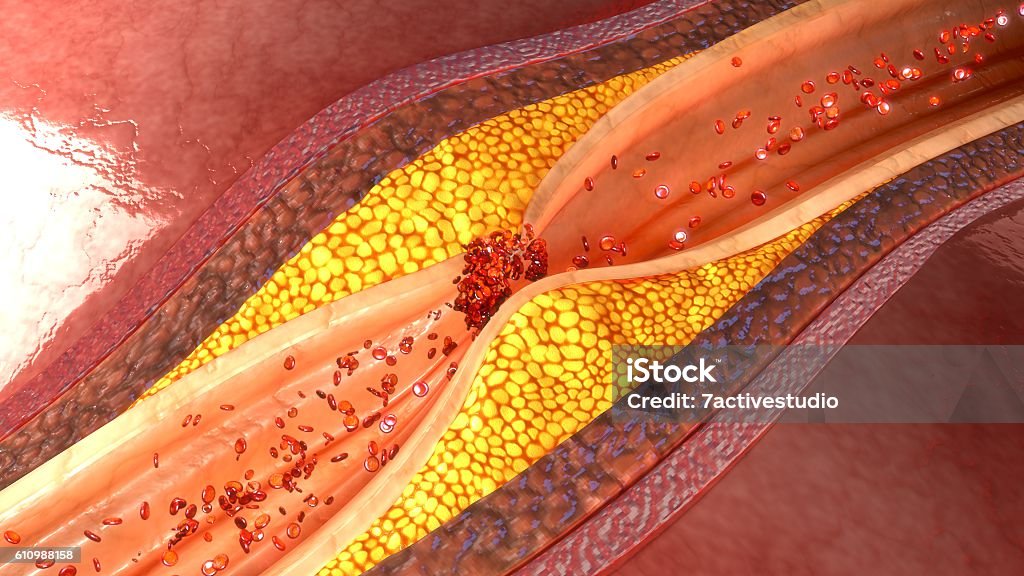 coronary artery plaque The arteries, which start out smooth and elastic, get plaque on their inner walls, which can make them more rigid and narrowed. This restricts blood flow to your heart, which can then become starved of oxygen. Coronary Artery Stock Photo
