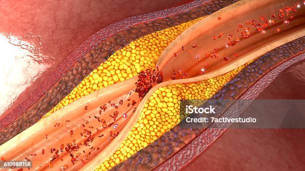 Coronary Artery Plaque Stock Photo - Download Image Now - Coronary Artery, Atherosclerosis, Hypertensive