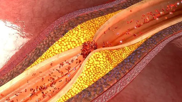 The arteries, which start out smooth and elastic, get plaque on their inner walls, which can make them more rigid and narrowed. This restricts blood flow to your heart, which can then become starved of oxygen.