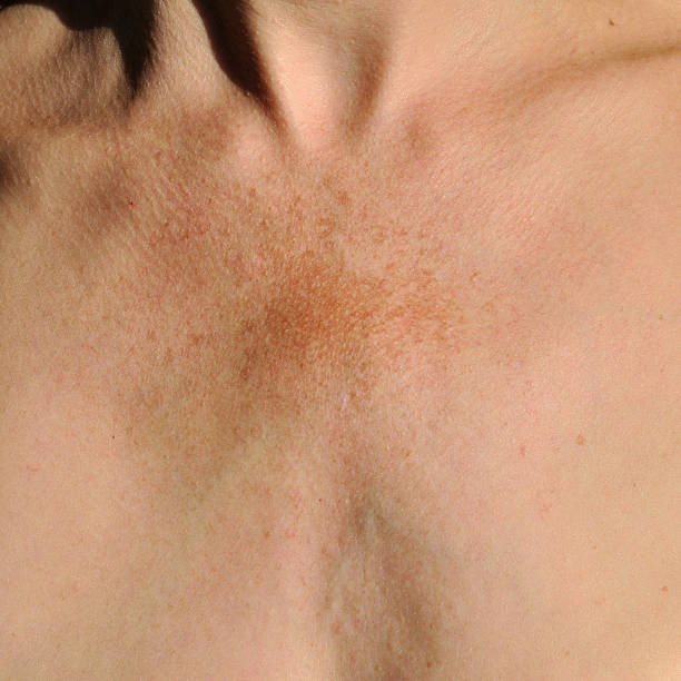 melasma: disturbo della pigmentazione cutanea - cleavage foto e immagini stock