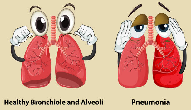 Diagram showing healthy and pneumonia lungs Diagram showing healthy and pneumonia lungs illustration clip art of a diagram of human lungs stock illustrations