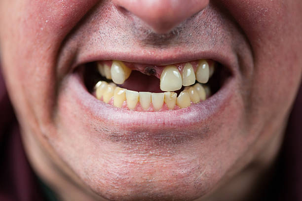 Toothless Man Close up of a mans mouth with two teeth missing. The one at the front has recently been removed and the wound is still visible. gap toothed stock pictures, royalty-free photos & images