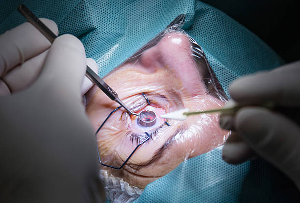 Eye surgery Woman with eye open in hospital and surgeon with medical equipment cornea stock pictures, royalty-free photos & images