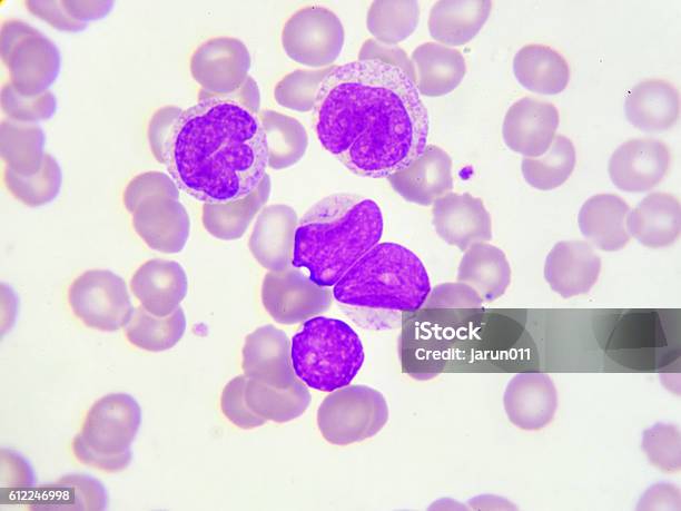 Leukemia Cells Stock Photo - Download Image Now - Chronic Granulocytic Leukemia, Anemia, Blood