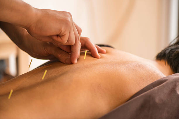 giovane donna al trattamento dell'agopuntura - acupuncture spa treatment asian culture medicine foto e immagini stock