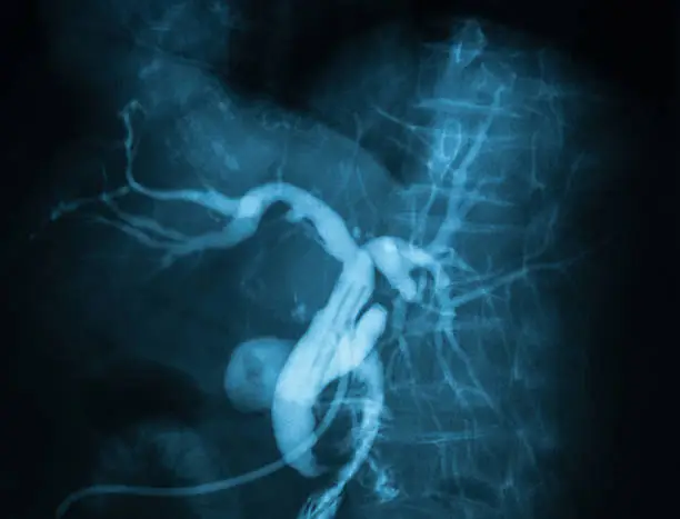 Radiography of hepatic arteriogram, left posterior oblique (LPO) view.