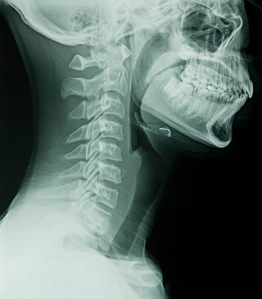 Lateral Cervical Spine X-Ray stock photo