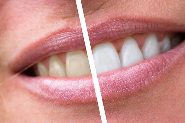 woman teeth before and after whitening