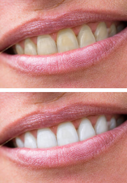 istock woman teeth before and after whitening 612411154