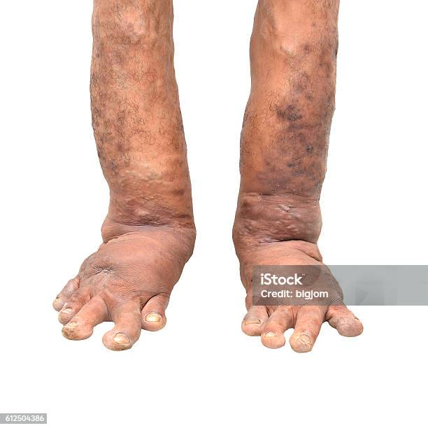 Foot Disorders On White Background Stock Photo - Download Image Now - Gout, Senior Adult, Arthritis