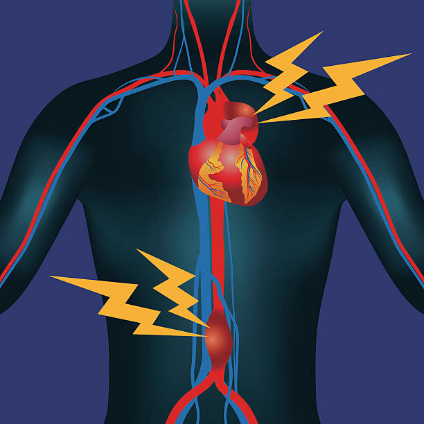 bildbanksillustrationer, clip art samt tecknat material och ikoner med abdominal aortic aneurysm and thoracic aortic aneurysm - aorta