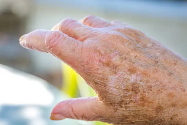 hands of an elderly woman with eczema or allergic skin problems