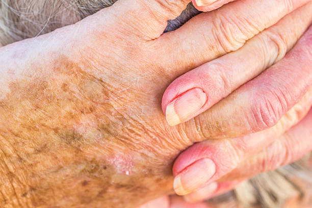 hands of old woman with skin problems hands of an elderly woman with eczema or allergic skin problems ugly old women stock pictures, royalty-free photos & images
