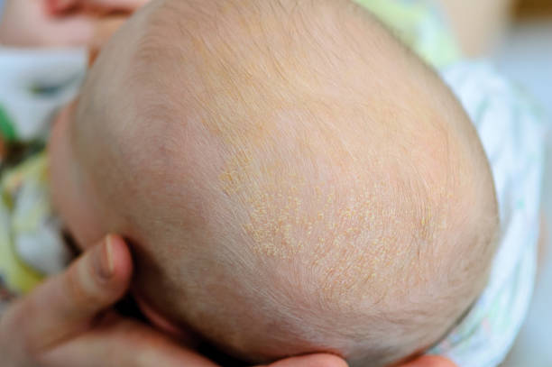 istock seborrheic crusts  on the head in infants 613017750