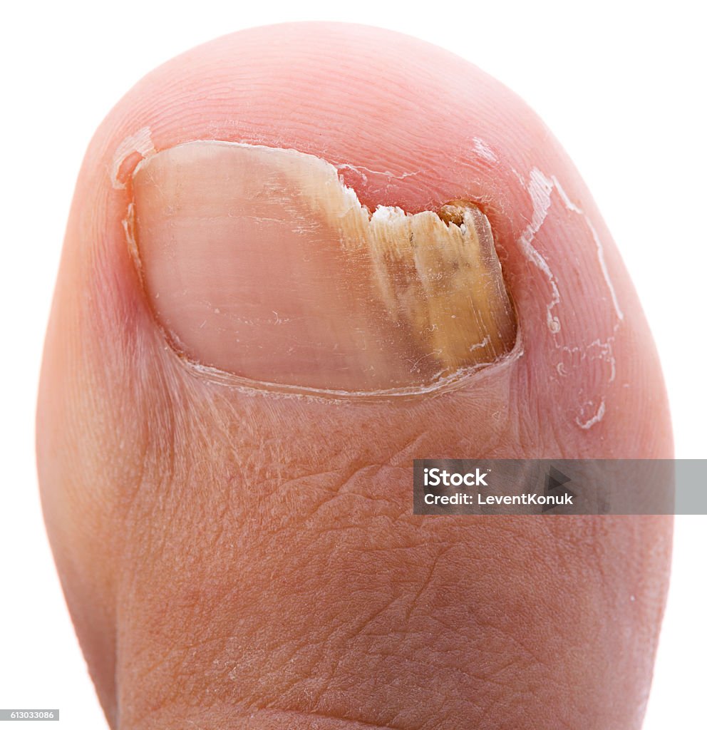 Giun Đũa Móng Tay Hình ảnh Sẵn có - Tải xuống Hình ảnh Ngay bây ...